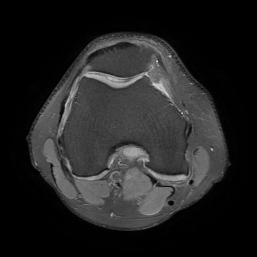 Bucket handle tear of medial meniscus Image