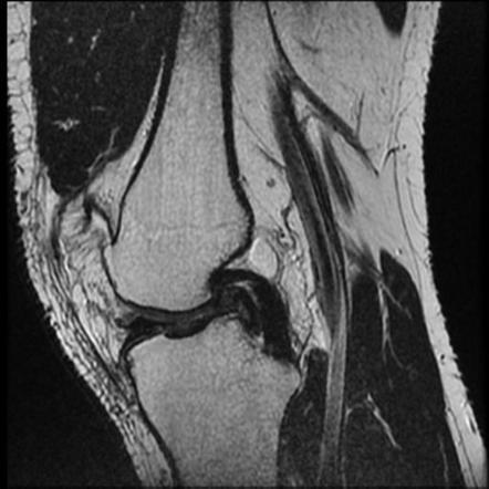 Double PCL sign | Radiology Reference Article | Radiopaedia.org