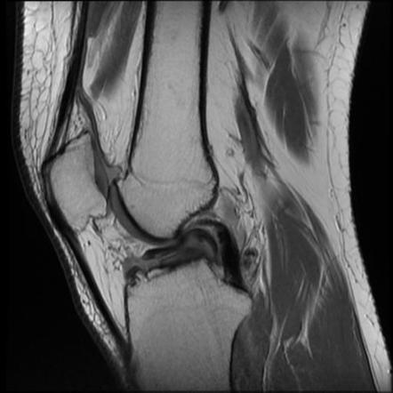 Bucket handle tear of medial meniscus | Image | Radiopaedia.org