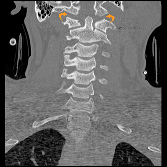 Atlanto-occipital dissociation injury | Image | Radiopaedia.org