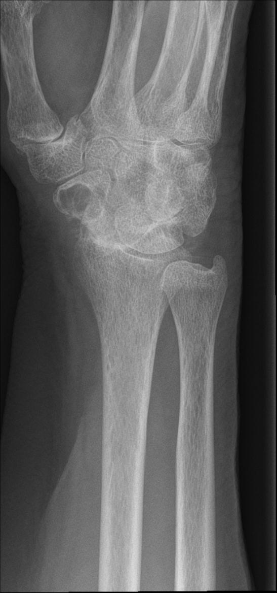 Calcium Pyrophosphate Deposition Arthropathy Wrist | Image ...