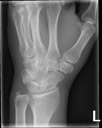 Subtle distal radius fracture | Image | Radiopaedia.org