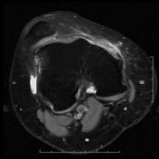 Medial collateral ligament injury grading