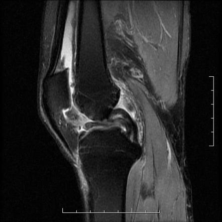 Double PCL sign | Radiology Reference Article | Radiopaedia.org