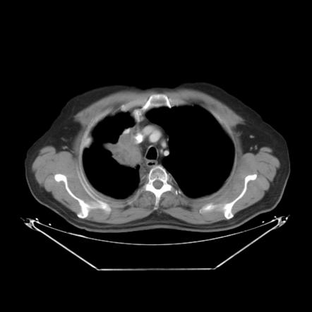 Lung Cancer | Radiology Reference Article | Radiopaedia.org