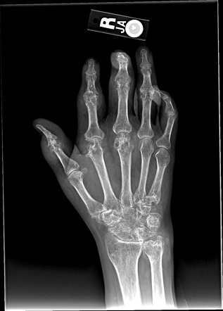 Gout | Radiology Reference Article | Radiopaedia.org