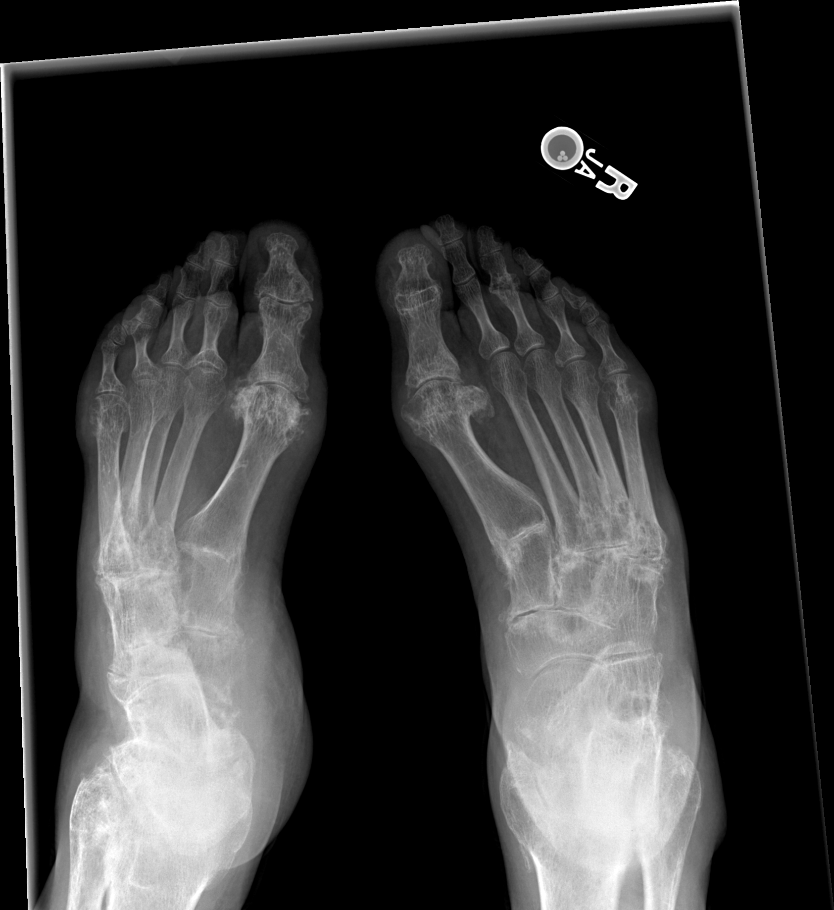 case study of gouty arthritis