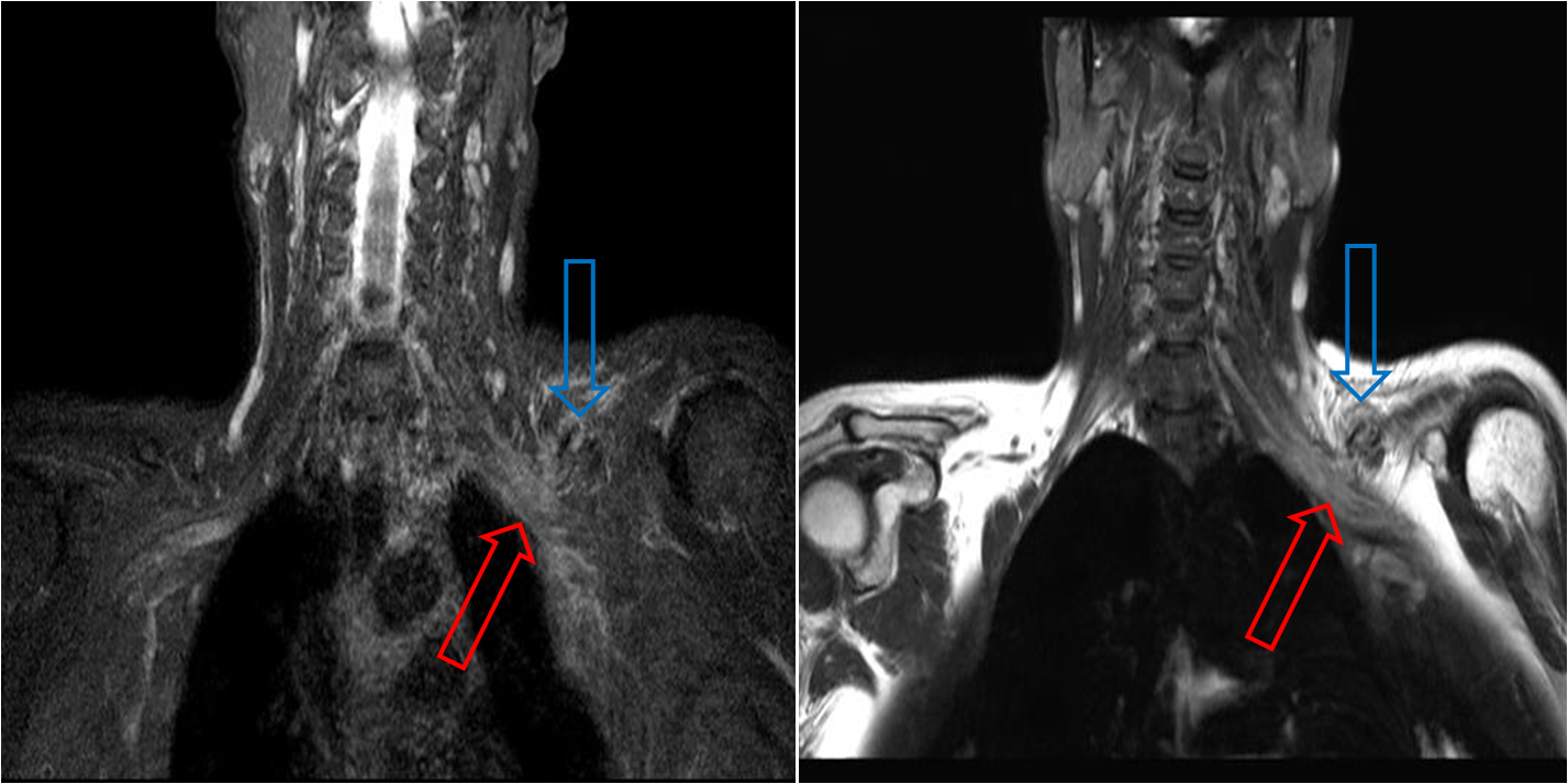 Traumatic brachial plexopathy | Image | Radiopaedia.org