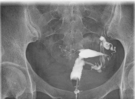 Salpingitis isthmica nodosa | Radiology Reference Article | Radiopaedia.org