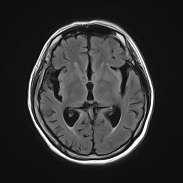 Early-onset familial Alzheimer's disease, PSEN1 mutation | Image ...