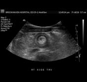 Bulls eye sign ultrasound