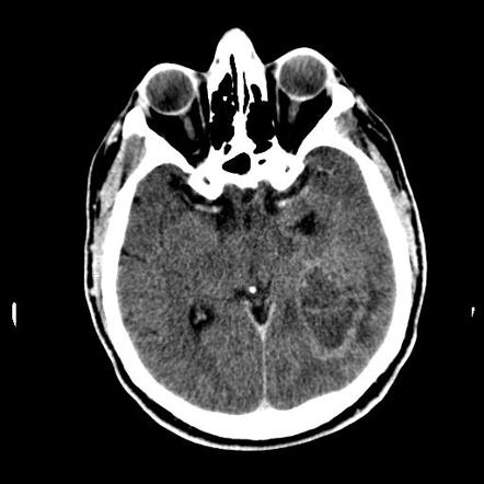 Glioblastoma NOS | Radiology Case | Radiopaedia.org