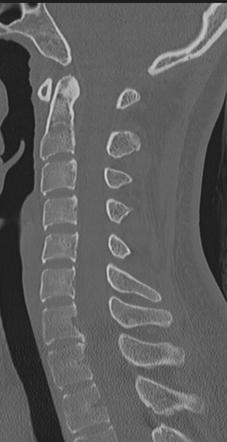 NEXUS score vs CT scan findings.