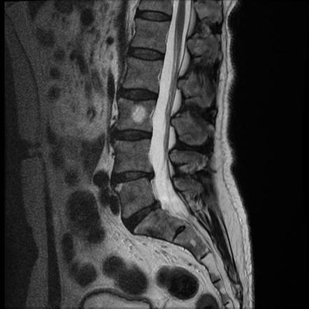 Disc protrusion compressing L5 nerve root | Image | Radiopaedia.org