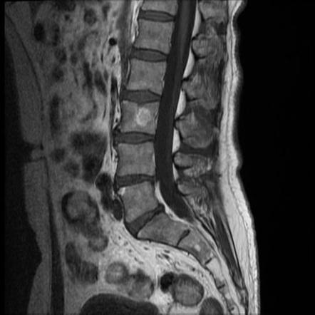 Disc protrusion compressing L5 nerve root | Image | Radiopaedia.org