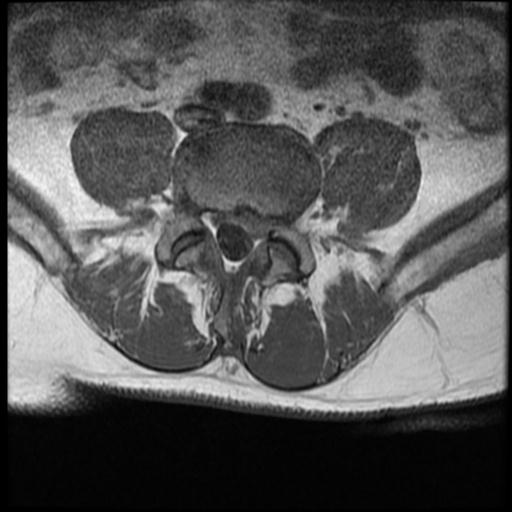 Disc protrusion compressing L5 nerve root | Image | Radiopaedia.org