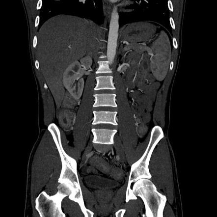 Ulcerative colitis | Image | Radiopaedia.org