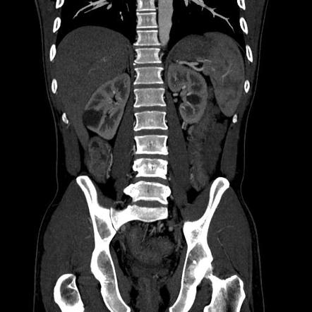 Ulcerative Colitis Radiology Reference Article Radiopaedia Org