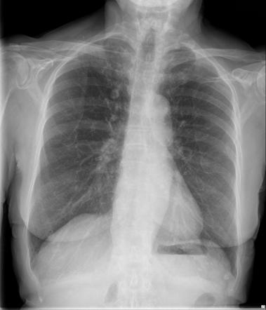 Coin lesion (lung) | Radiology Reference Article | Radiopaedia.org