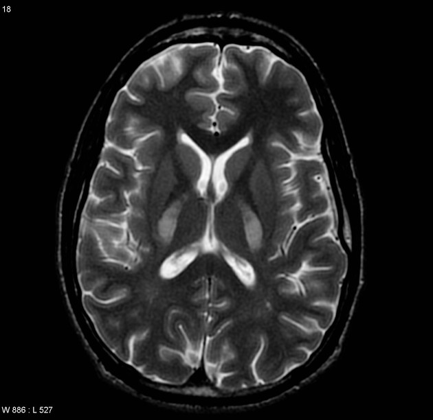 Radiological Patterns in Toxic Leukoencephalopathy