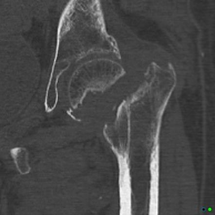 Fracture non-union | Radiology Reference Article | Radiopaedia.org