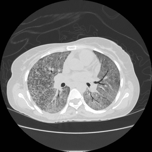 Transbronchial Lung Biopsy (TBLB) In Diagnosing Pulmonary