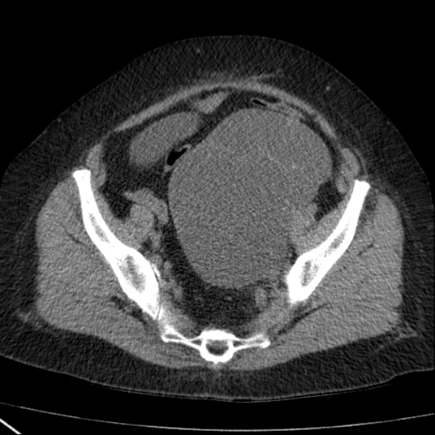 Ovarian Serous Cystadenoma Image