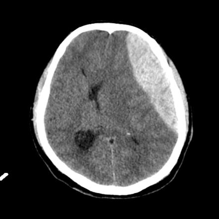 Subfalcine herniation | Radiology Reference Article | Radiopaedia.org