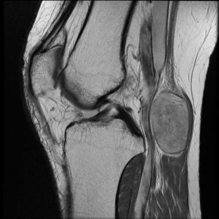 Peripheral nerve sheath tumor of sciatic nerve | Radiology Case ...