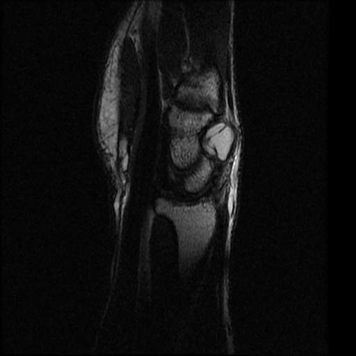 Triangular fibrocartilage complex (TFCC) tear with avulsion fracture of ...