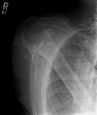 Primary hyperparathyroidism with brown tumor | Image | Radiopaedia.org