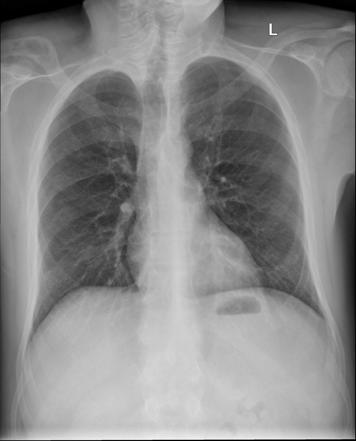 Distal clavicular erosion (differential) | Radiology Reference Article ...