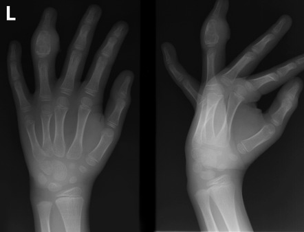 Dermatitis as related to Coccidioidomycosis - Pictures