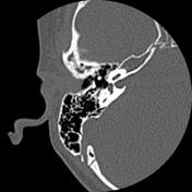 Radiopaedia - Drawing Middle ear ossicles: malleus, incus and