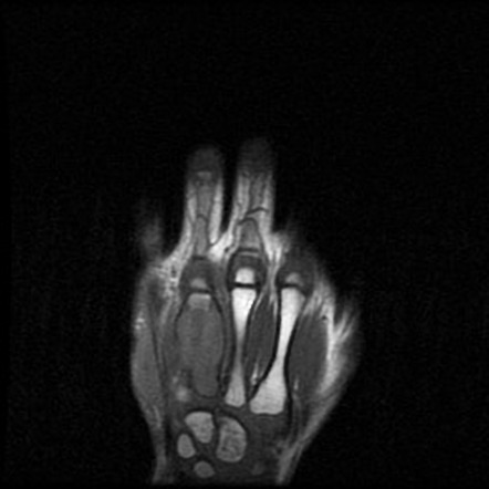 Coccidioidomycosis infection - musculoskeletal involvement | Image ...