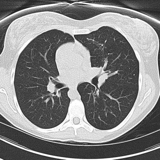 Immotile cilia syndrome | Image | Radiopaedia.org