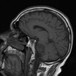 Acoustic schwannoma - cystic | Image | Radiopaedia.org