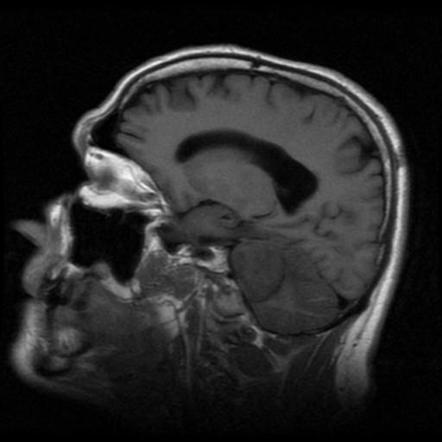 Acoustic schwannoma | Image | Radiopaedia.org