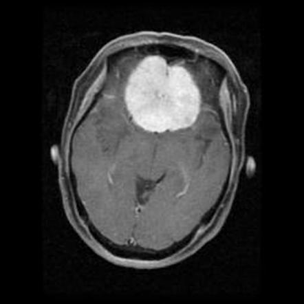 Olfactory groove meningioma | Radiology Case | Radiopaedia.org