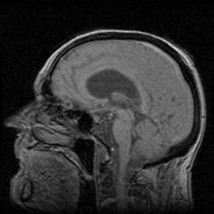 Multiple Intracranial Meningiomas 