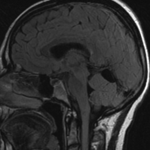 Supravermian arachnoid cyst | Image | Radiopaedia.org