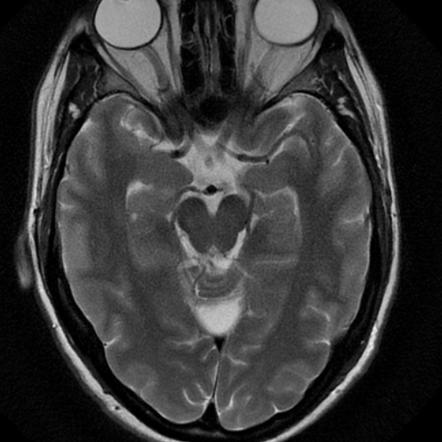 Arachnoid cyst | Radiology Reference Article | Radiopaedia.org