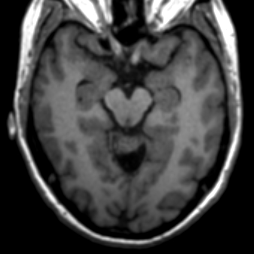 Supravermian arachnoid cyst | Image | Radiopaedia.org