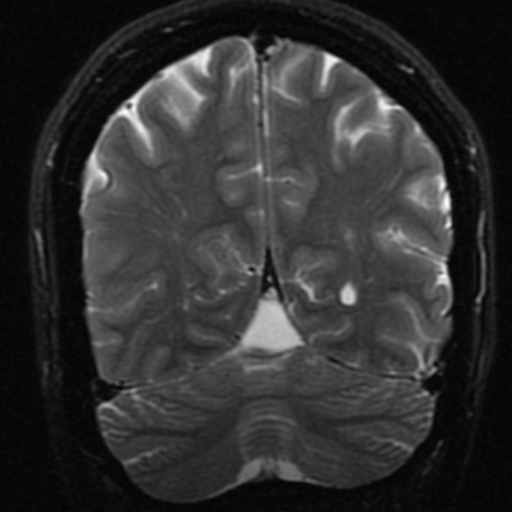 Supravermian Arachnoid Cyst 