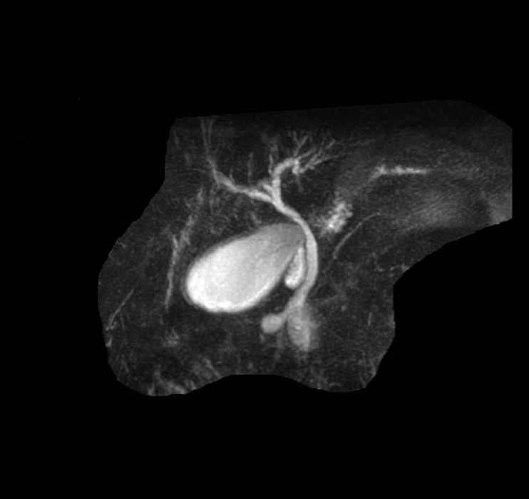 Мрт холангиография. Дивертикул желчного пузыря кт. Магнитно-резонансная холангиография.