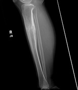 Brodie abscess Radiology Case Radiopaedia