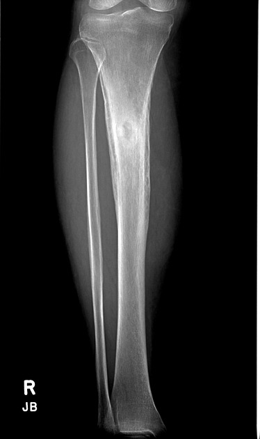 Brodie abscess Radiology Case Radiopaedia