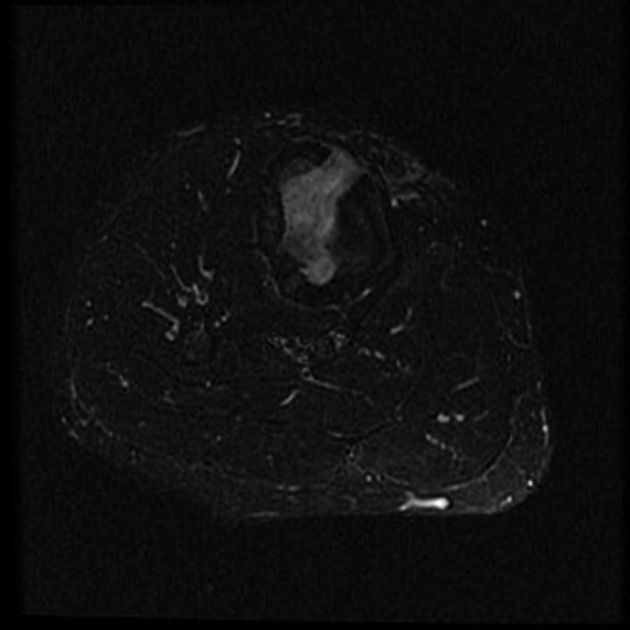 Brodie abscess Radiology Case Radiopaedia