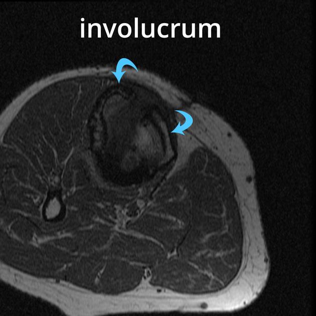 Brodie abscess Radiology Case Radiopaedia