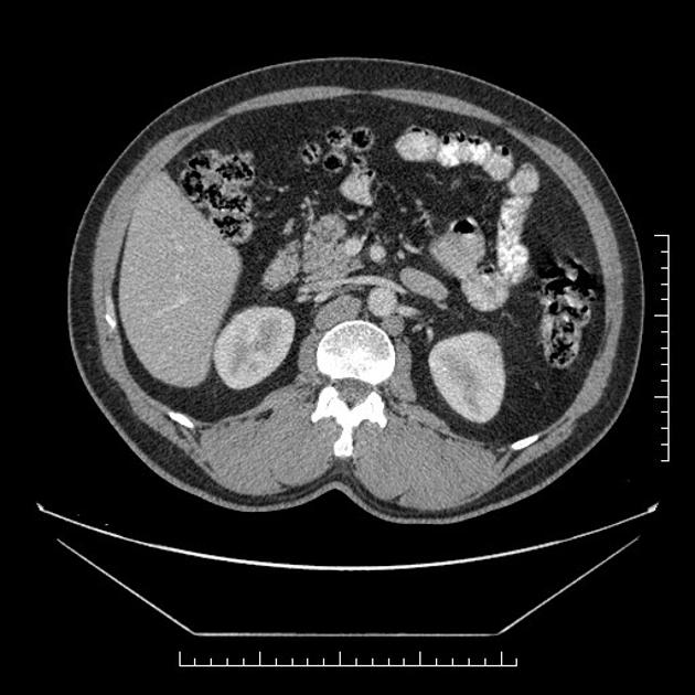 Extra Adrenal Pheochromocytoma Radiology Case Radiopaedia Org